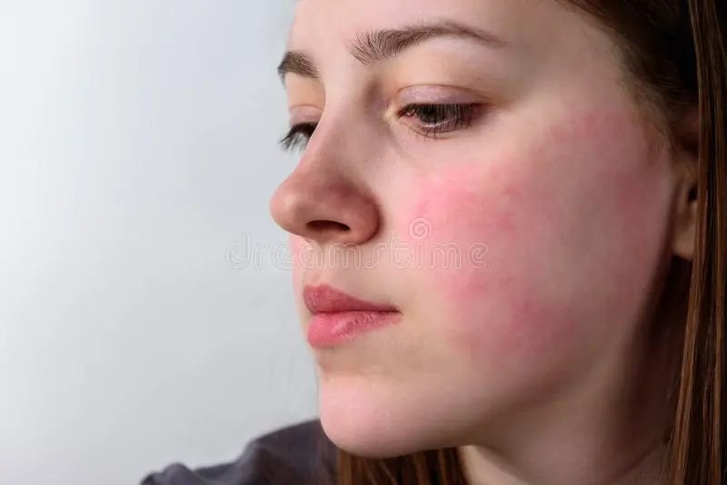 Close up of sensitive face skin showing mild redness and flushing